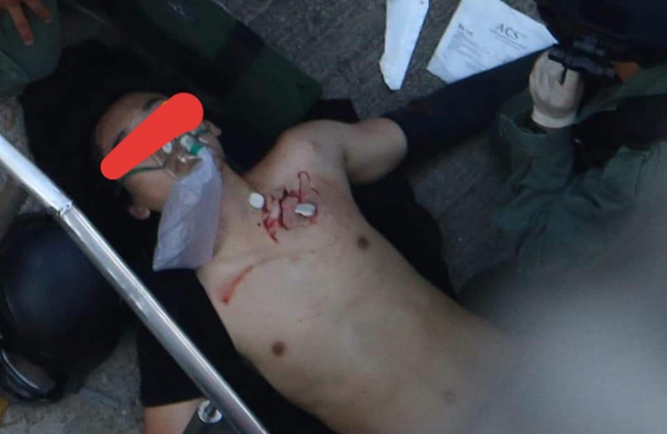 10月1日的反送中抗爭中香港警察朝一名年輕男子發射實彈導致其左胸受傷恐有生命危險（圖片來源：看中國）