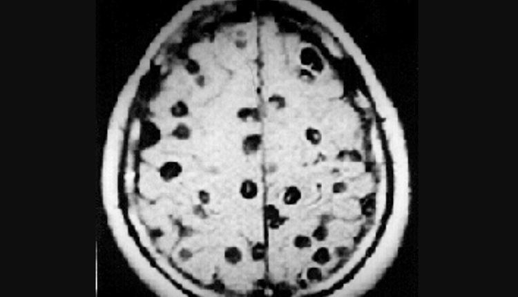 神經囊蟲患者的磁力共振掃描（MRI）圖像