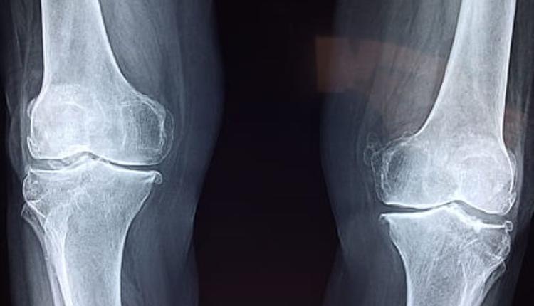 膝盖X射线