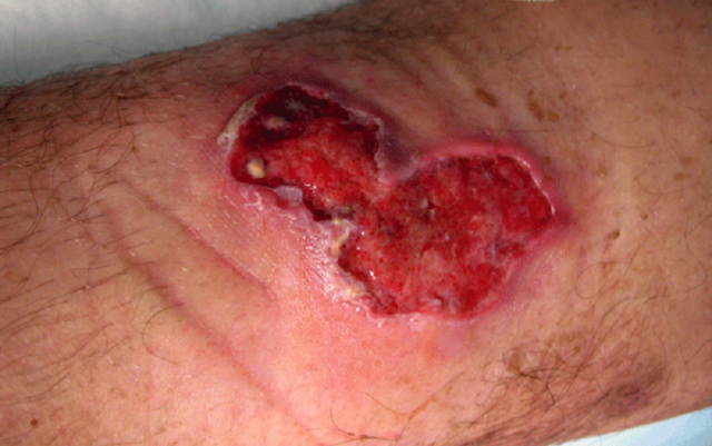 Buruli ulcer